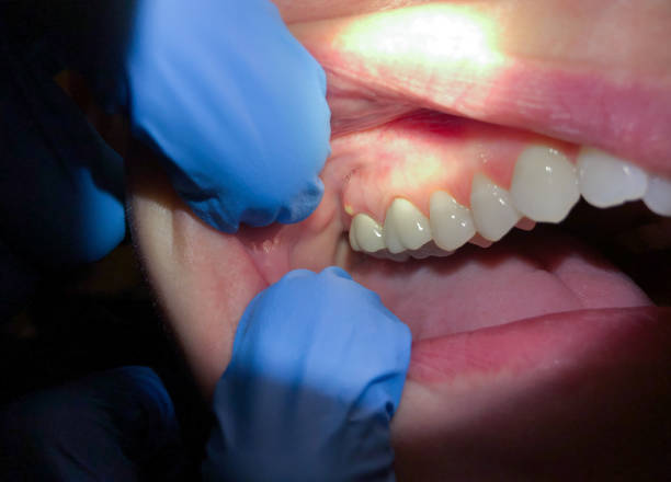 Best Emergency Dentist for Lost Fillings or Crowns in Croydon, PA